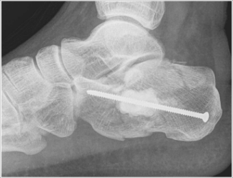 Calcaneus fracture with bone substitute material