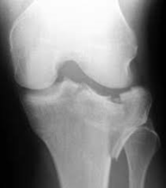 ap radiography of typical tibia head impression fracture