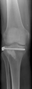 tibia head impression fracture with bone substitute material (BSM) and screws